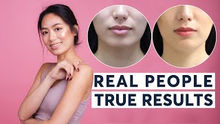 HIFU Skin Tightening  Real People True Results [upl. by Lenra]