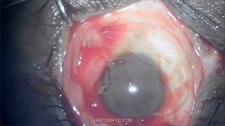 Pterygium excision with autograft By Dr K L Agrawal [upl. by Artina]