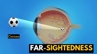 Farsightedness Causes Signs and Symptoms Diagnosis and Treatment [upl. by Akemhs]