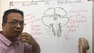 bulbar palsy vs pseudobulbar palsy [upl. by Jacquelyn]