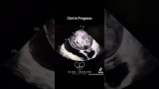 Severe Mitral Stenosis amp Atrial Thrombus Formation echocardiography echocardiogram cardiology [upl. by Sewellyn]