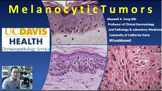 DERMATOPATHOLOGY Melanocytic Tumors [upl. by Clarhe]