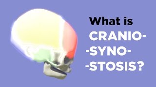 What is Craniosynostosis [upl. by Piero]