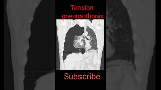 Tension Pneumothorax shorts radiological education chestpathology [upl. by Scarito]