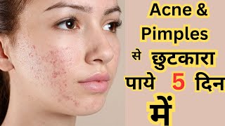 कील मुहासो acne की दवा Clindamycin phosphate gel  usesmechanism of action  Clinsol Gel review [upl. by Ennahteb]