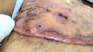 A Big Keloid covering entire chest with ulceration Chronic Keloid Hypertrophic scar क्षतांक [upl. by Ardaed]