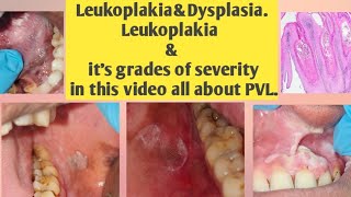 Leukoplakia and DysplasiaLeukoplakia amp its grades of severitythis video all type Leukoplakiaamp PVL [upl. by Aramois873]