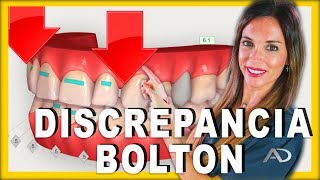 👩🏻‍⚕️Discrepancia de BOLTON👨🏻‍⚕️Analisis de la discrepancia de BOLTON en ORTODONCIA [upl. by Pettifer703]