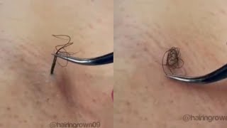 Removing Long Ingrown Hair From Armpit [upl. by Yrokcaz662]