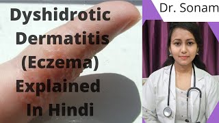 Dyshidrotic Eczema  Causes  Symptoms  Diagnosis amp Treatment [upl. by Meeker]