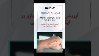 Keloid meaning keloid sentence English vocabulary [upl. by Airdnaid]