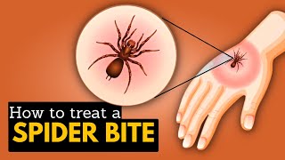 How to Treat A Spiders Bite [upl. by Ttocserp]