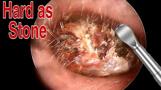 BIGGEST Ear Wax Difficult Removal  EP2  Doctor Anh [upl. by Antonetta]