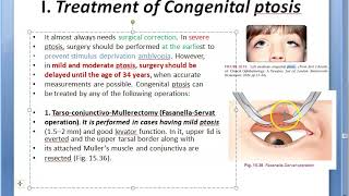 Ophthalmology 388 d Ptosis Treatment FasanellaServat Frontalis sling eye surgery eye lid droop [upl. by Bassett]