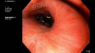 prothèse oesophagienne pour sténose caustique de loesophage Dr Sami Boudabbous [upl. by Dammahum859]