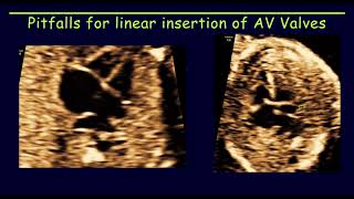 Normal variants and pitfalls in fetal echocardiography [upl. by Suraved460]