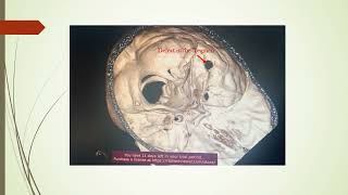 This video shows the defect on the Tegmen with 3D reconstruction of temporal bone [upl. by Ailegnave]