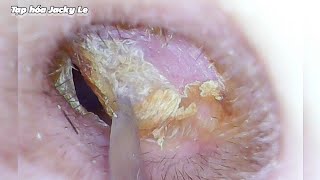 Ear Wax Removal 115 It Feels Great As Each Layer Of Earwax Is Removed  Ear Cleaning ASMR [upl. by Dominic847]