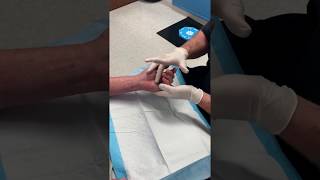 Dupuytren’s Contracture Release with Xiaflex Injection [upl. by Anir756]