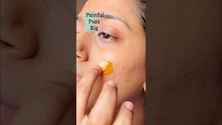 How I treat my hormonal Acne overnight  Pimple Honeyturmeric shorts [upl. by Iadrahc796]