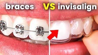 Invisalign vs Braces what you NEED to ask your dentist [upl. by Lorola727]