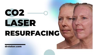 The Incredible Transformation CO2 Laser Resurfacing Before and After [upl. by Mcgannon]