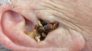 Ear Wax Removal Ear Wax Cleaning [upl. by Nyladnohr]