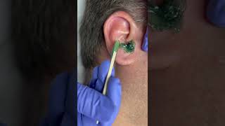 Professional male ear wax using hard wax from Nacach esthetician [upl. by Reeba648]