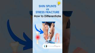 Shin Splints vs Stress Fracture physicaltherapy physiotheraphy shinsplints [upl. by Assenar]