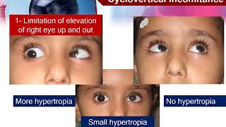 13 Motor evaluation of strabismus Comitant and noncomitant strabismus [upl. by Trofmoc213]