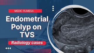 Endometrial Polyp on Transvaginal ultrasound  Radiology case 6 [upl. by Essie]