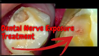 68 Deep tooth decay leads to nerve exposure [upl. by Erolyat]