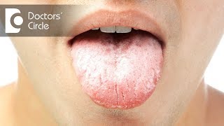 Causes and symptoms of oral thrush  Dr Jayaprakash Ittigi [upl. by Merv689]