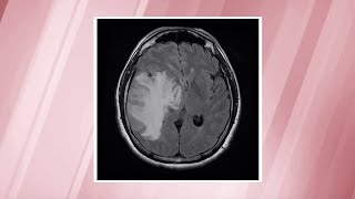 Glioblastoma—the most commonlydiagnosed brain cancer  OSUCCC – James [upl. by Corrianne]