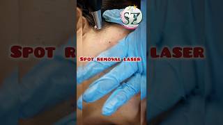 spot removal permanently spots removal laser therapylaser ndyag shortsfeed beauty skincare [upl. by Millman638]