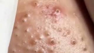 Black pimples  very old blackheads on face  black heads white heads removal hacks 😷 [upl. by Novyart]