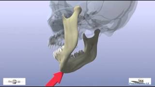 fractures of the mandibular condyle [upl. by Almeeta]