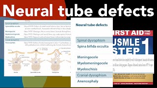 Neural tube defects Spina bifida occulta Meningocele Myelomeningocele Myeloschisis Anencephaly [upl. by Ettennyl]