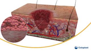 Wound Healing [upl. by Marijane]