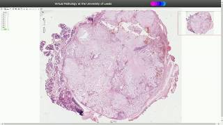 Pleomorphic Adenoma  Histopathology [upl. by Darrow351]