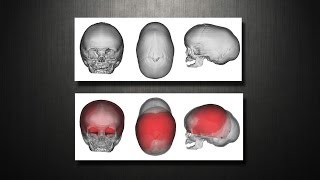 Craniosynostosis  Virtual Cranial Vault skull Reconstruction [upl. by Feer]