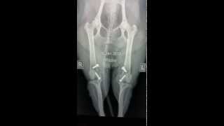 RidgeStop prosthetic trochlear ridge  pre and post op xrays [upl. by Mandych]