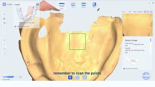 Intraoral Scanner Edentulous Scan Case Guidance [upl. by Nawor]