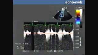 TheEchoWeb  Idiopathic Hypertrophic Subaortic Stenosis IHSS [upl. by Aninotna]