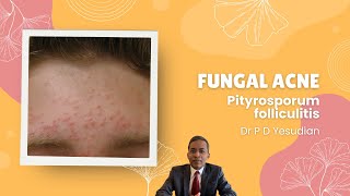 Pityrosporum or Malassezia folliculitis fungal acne [upl. by Fabyola]