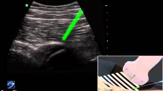 How To Hip UltrasoundGuided Injection of the Proximal Hamstring 3D Video [upl. by Kendricks309]