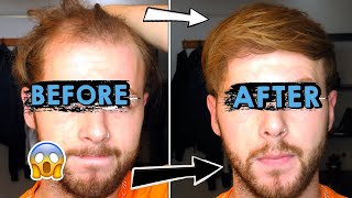 Going bald at 25  How I style my thinning receding hair [upl. by Sellig]