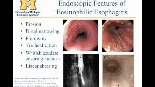 Eosinophilic Esophagitis Matthew Greenhawt MD [upl. by Nerok]