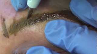 Permanent Makeup Brows Tutorial by Linda Dixon MD [upl. by Rafiq391]