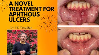 A new treatment for apththous ulcers canker sores [upl. by Clemmy]